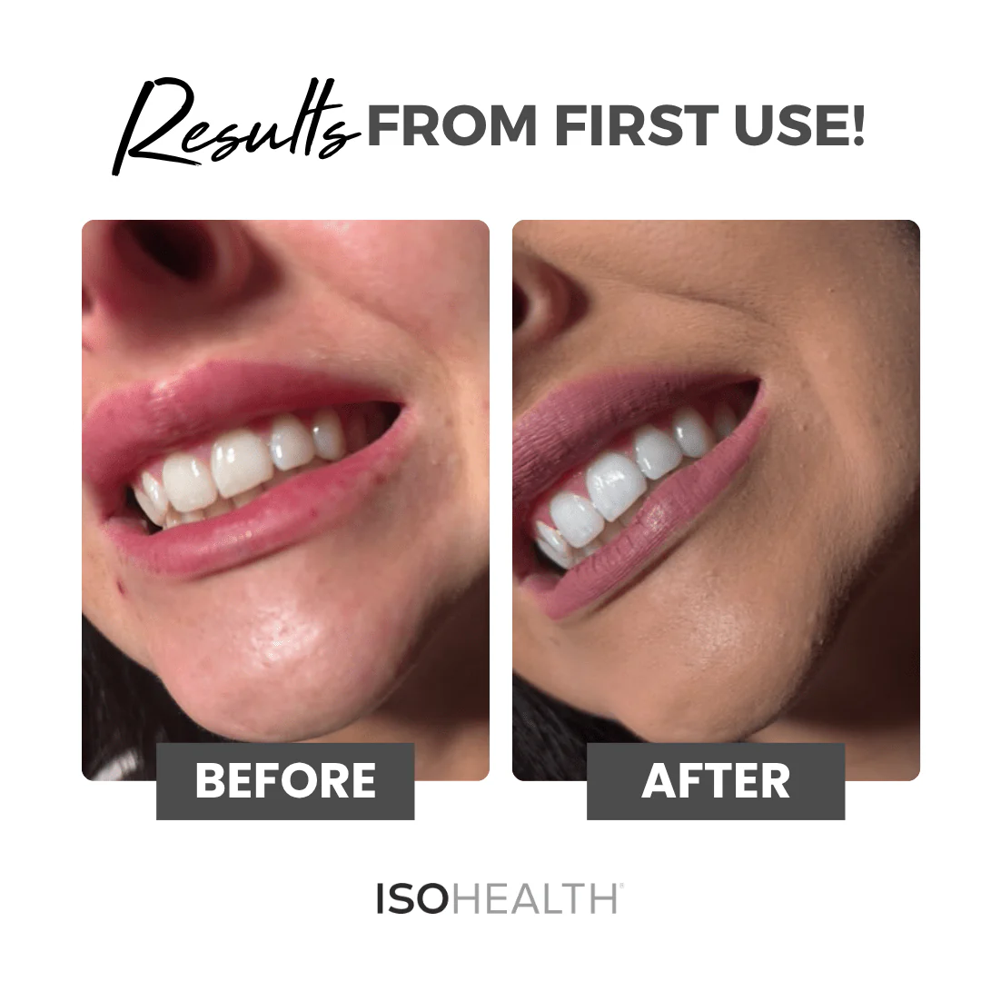 Teeth Whitening Strips (28 strips) Available In Clear Or Carbon - Image 4